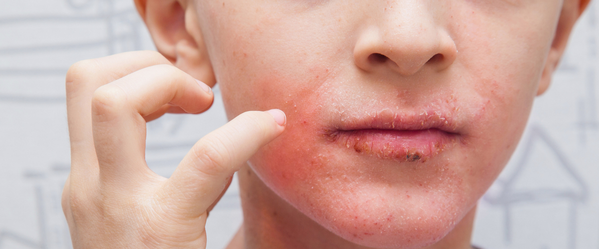 Atooppinen ihottuma kasvoissa ja vinkkejä ärtyneen ihon rauhoittamiseen